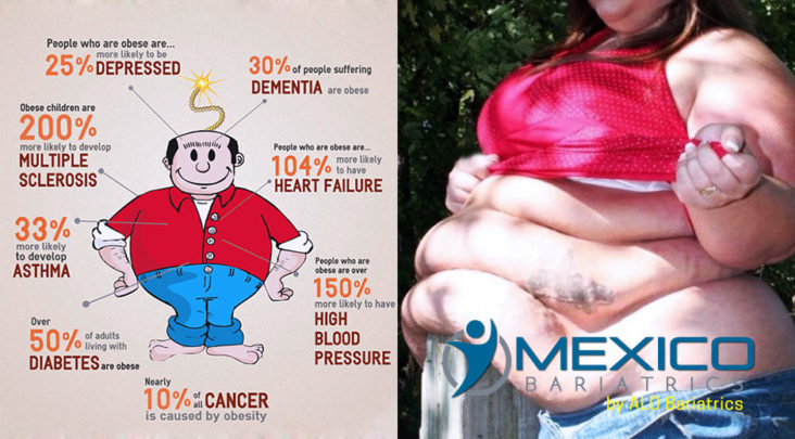 Obesity is a complex disease that is associated with a number of comorbidities, increased mortality, and reduced quality of life.