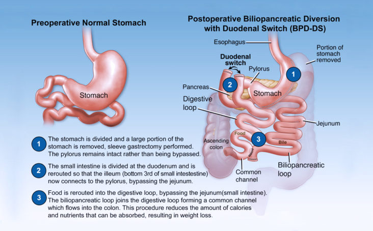Dr. Jaime Ponce de Leon, Duodenal Switch specialist in Tijuana, Mexico.